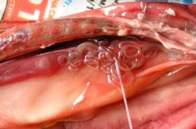 fluke in the gall bladder